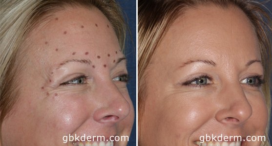 Botox to the forehead and temples provides natural-looking results